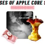 Causes of Apple Core Sign Mnemonic