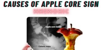 Causes of Apple Core Sign Mnemonic