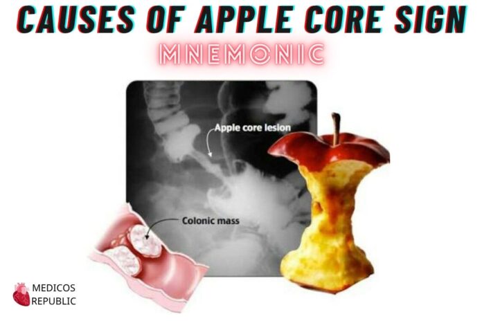 Causes of Apple Core Sign Mnemonic