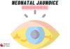 Causes of Neonatal Jaundice Mnemonic: “J.A.U.N.D.I.C.E”