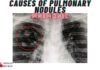 Causes of Pulmonary Nodules Mnemonic