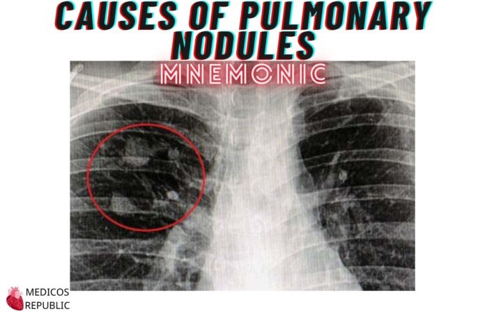 Causes of Pulmonary Nodules Mnemonic