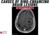 Causes of Ring-Enhancing Brain Lesions