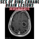 Causes of Ring-Enhancing Brain Lesions