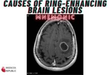 Causes of Ring-Enhancing Brain Lesions