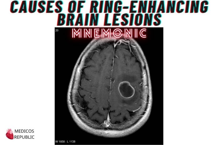 Causes of Ring-Enhancing Brain Lesions