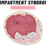 Compartment Syndrome Mnemonic – "5 P’s"