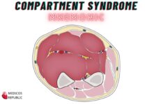 Compartment Syndrome Mnemonic – "5 P’s"