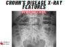Crohn’s disease X-Ray Features Mnemonic