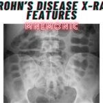 Crohn’s disease X-Ray Features Mnemonic