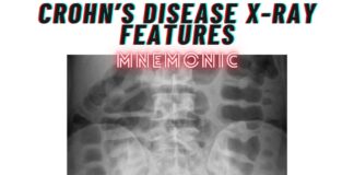 Crohn’s disease X-Ray Features Mnemonic