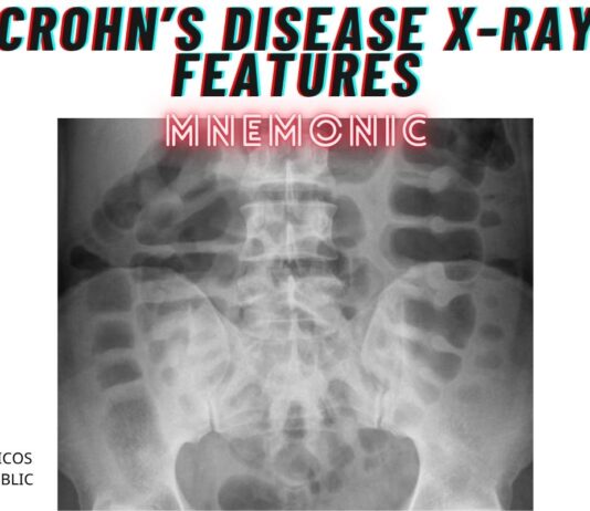 Crohn’s disease X-Ray Features Mnemonic