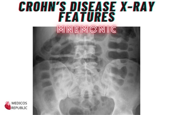 Crohn’s disease X-Ray Features Mnemonic