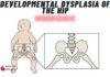 Developmental Dysplasia of the Hip Mnemonic
