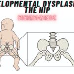 Developmental Dysplasia of the Hip Mnemonic