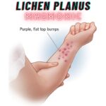 Lichen Planus Mnemonic: "6 P's"