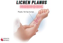 Lichen Planus Mnemonic: "6 P's"