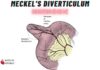 Meckel’s Diverticulum Mnemonic