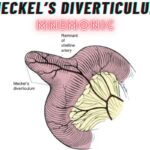 Meckel’s Diverticulum Mnemonic
