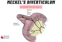 Meckel’s Diverticulum Mnemonic