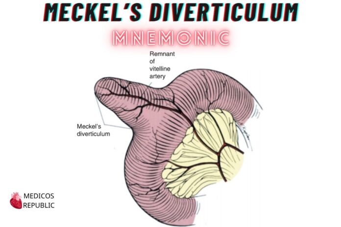 Meckel’s Diverticulum Mnemonic