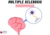 Multiple Sclerosis Symptoms Mnemonic