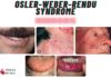 OSLER-WEBER-RENDU SYNDROME Mnemonic