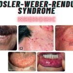 OSLER-WEBER-RENDU SYNDROME Mnemonic