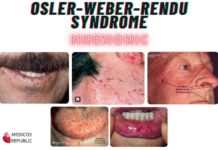 OSLER-WEBER-RENDU SYNDROME Mnemonic