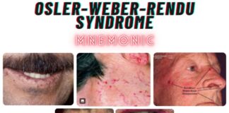 OSLER-WEBER-RENDU SYNDROME Mnemonic