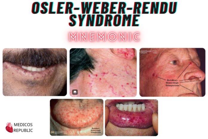OSLER-WEBER-RENDU SYNDROME Mnemonic