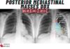 Posterior Mediastinal Masses DDx Mnemonic