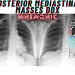 Posterior Mediastinal Masses DDx Mnemonic