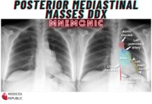 Posterior Mediastinal Masses DDx Mnemonic