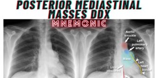 Posterior Mediastinal Masses DDx Mnemonic
