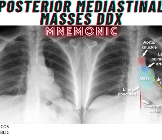 Posterior Mediastinal Masses DDx Mnemonic