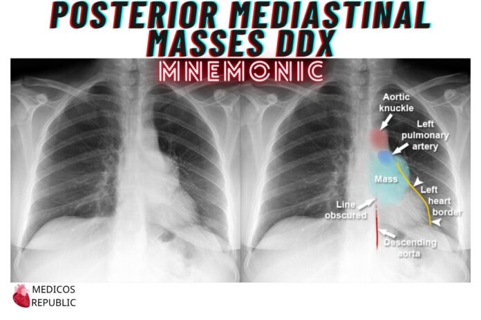 Posterior Mediastinal Masses DDx Mnemonic