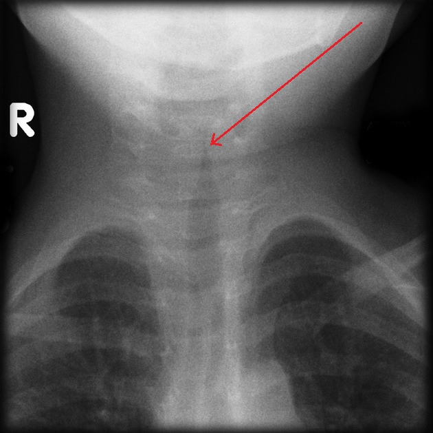 Croup with steeple sign
