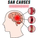 Subarachnoid Hemorrhage Causes Mnemonic