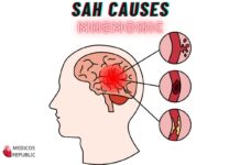Subarachnoid Hemorrhage Causes Mnemonic